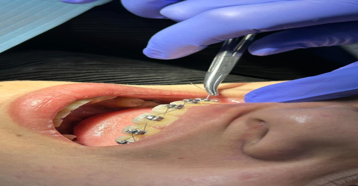 My Braces Feel Fine. Do I Really Need This Appointment